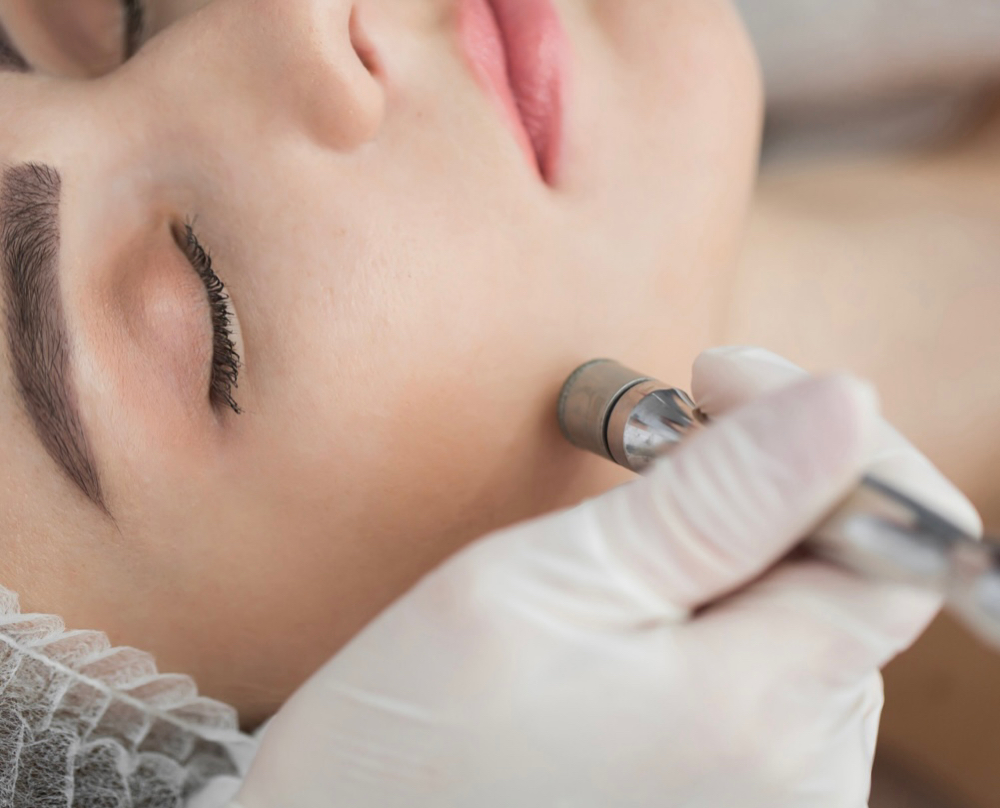 Renew Microdermabrasion Treatmet