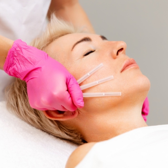 PDO Thread Lift at The Rejuvenation Suite Med Spa in New Rochelle, NY