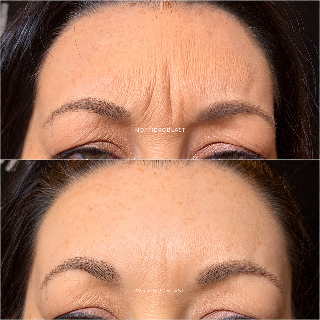 FIBROBLAST | FRENTE Y ENTRECEJO at EROXSPA in Houston, TX