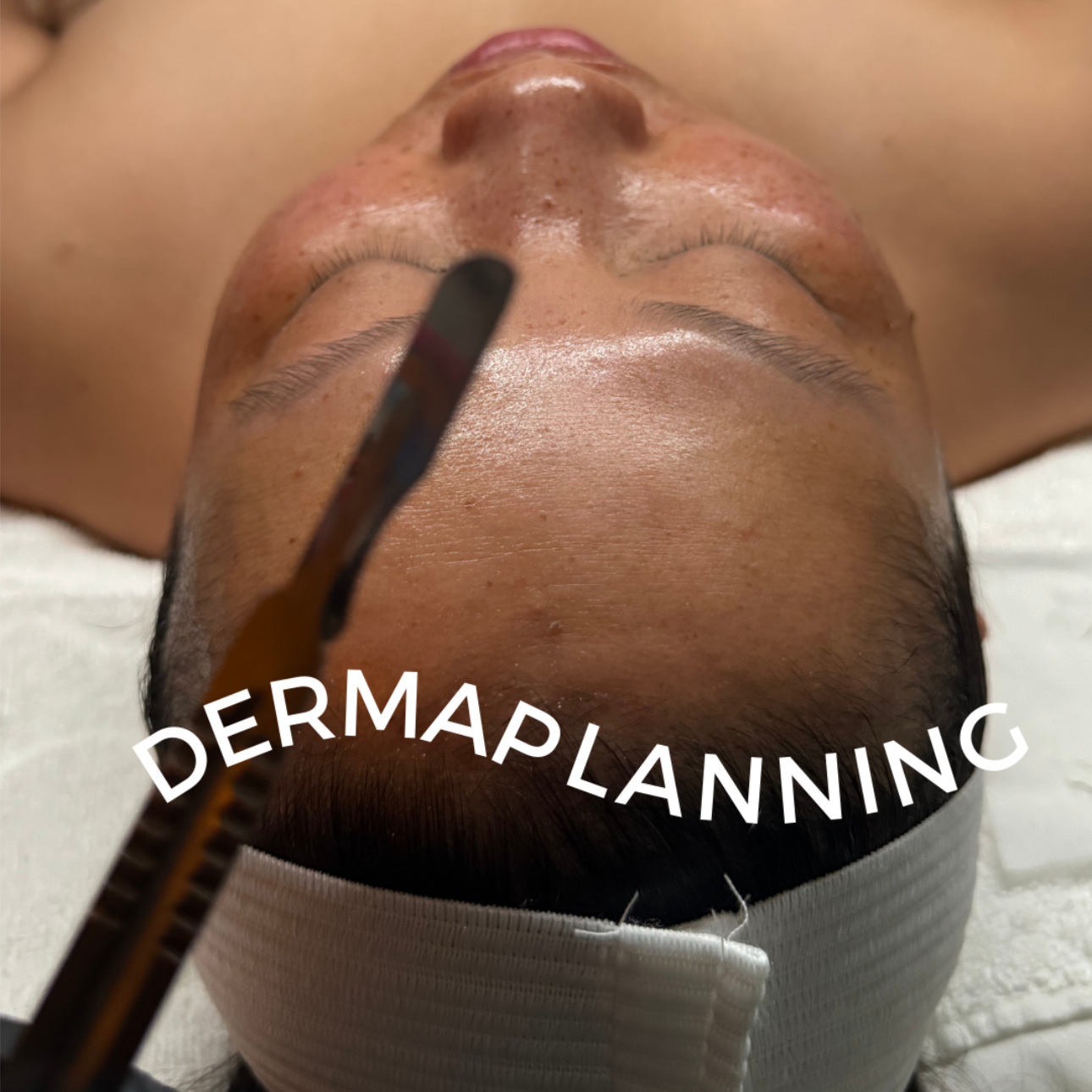Peachy Skin - Dermaplanning at Coco Aesthetics Medspa in Austin, TX