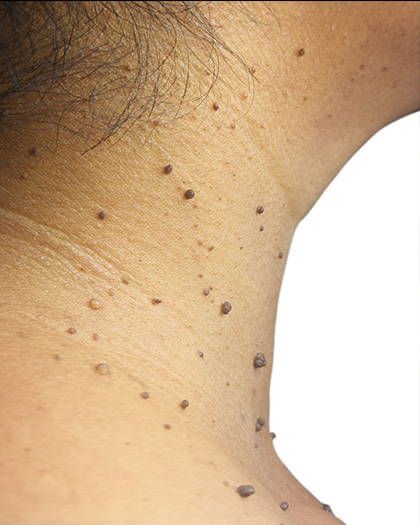 Skin tag Removal