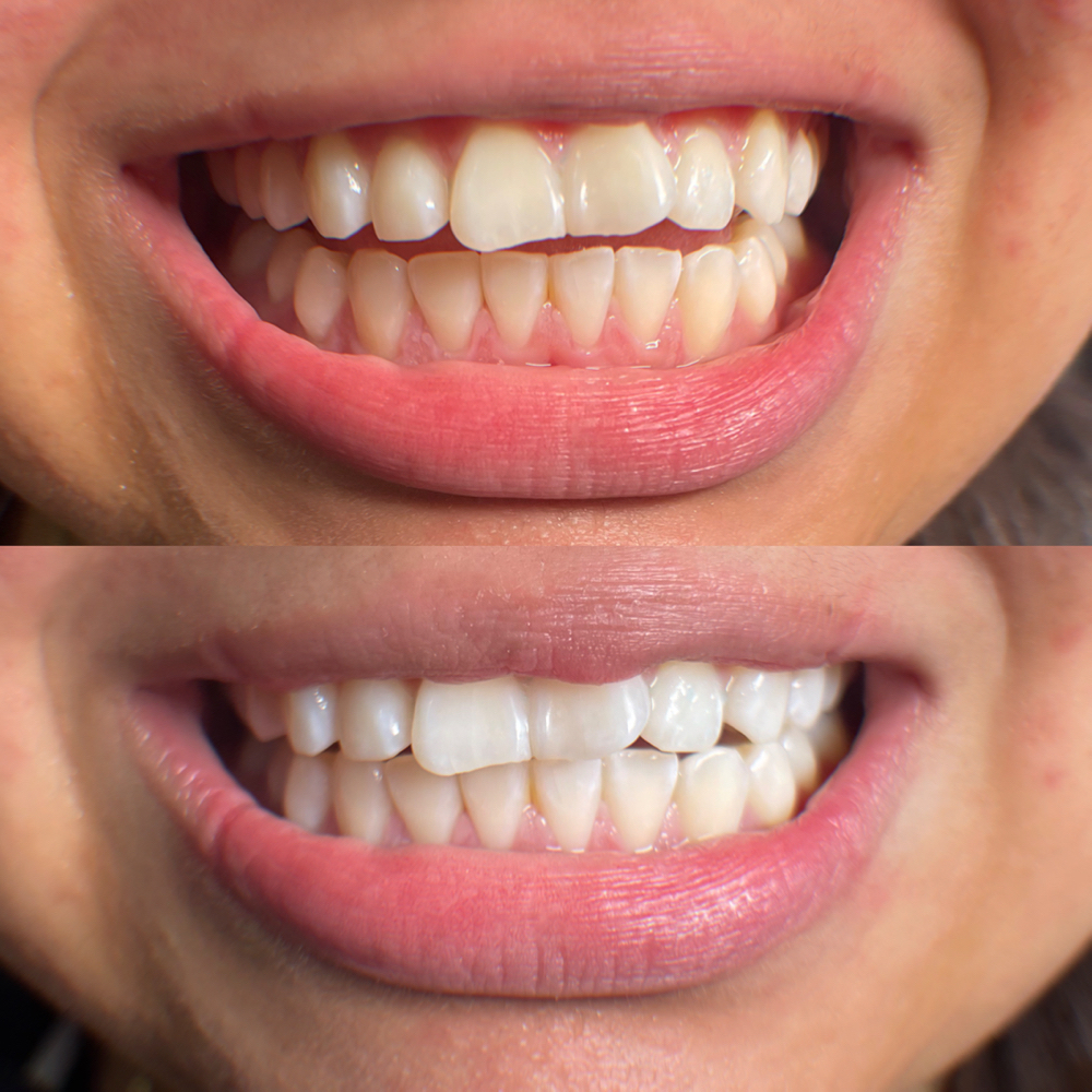 Teeth Whitening 60 Min Session