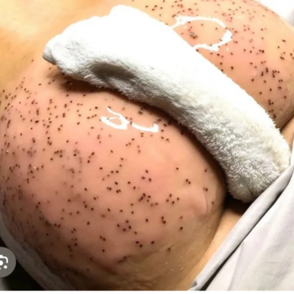 Butt Facial at Esthetics With Michaela in Vidalia, LA