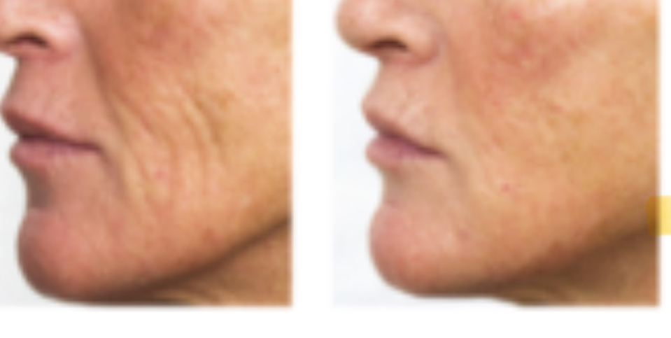 Intense Biorevitalizing Facial