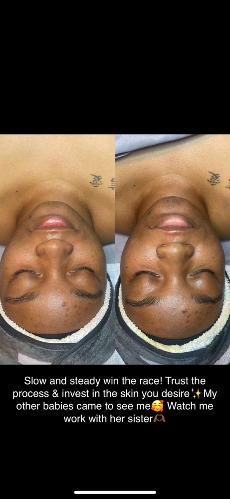 Acne Facial