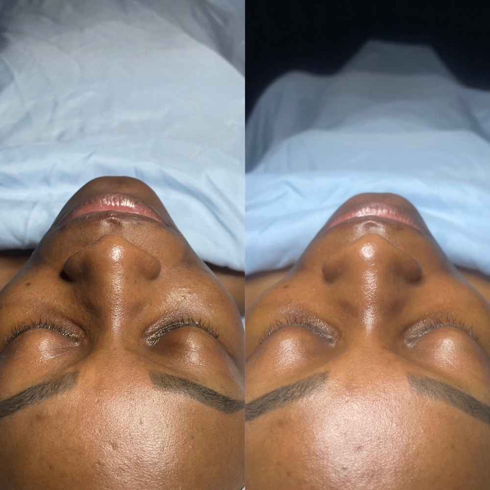 Acne Facial at Reflections Within Spa in Sharpsburg, GA