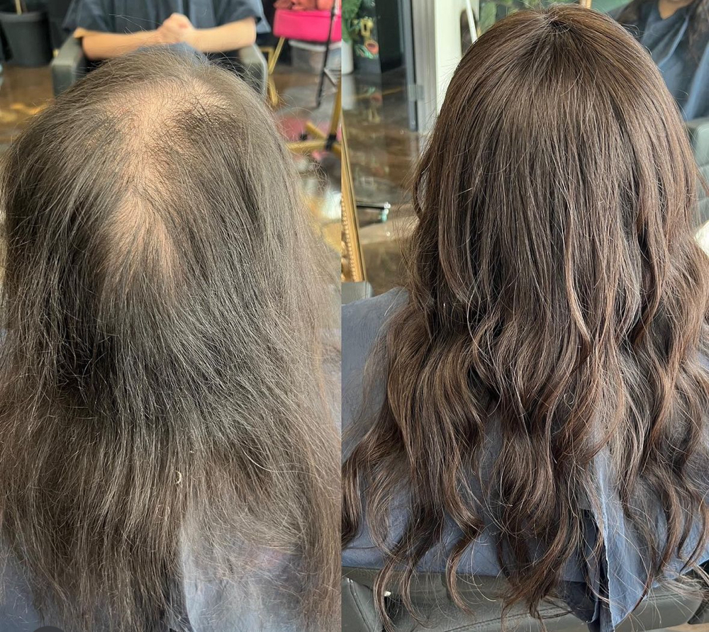 Hair Replacement Consultation