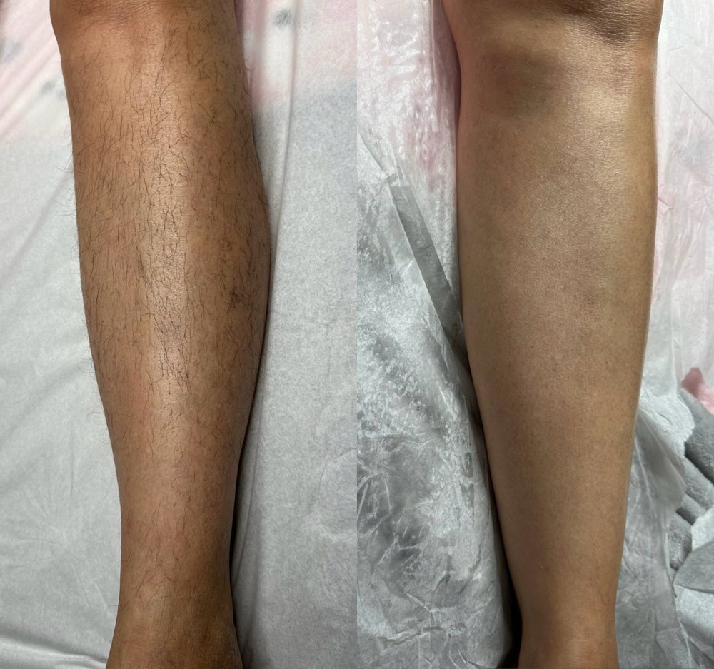 Full Leg