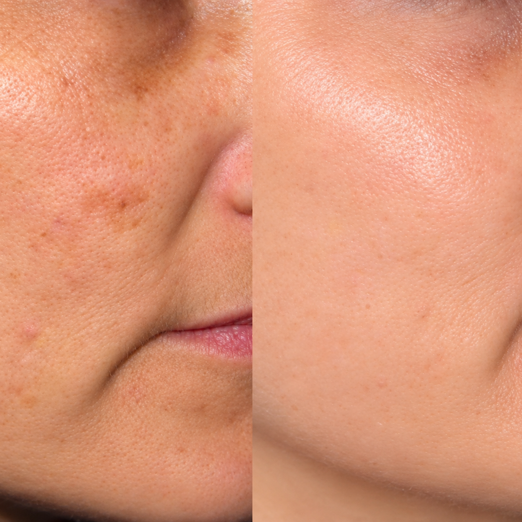 IPL Photofacial + LED at Skin Corrective Aesthetics in Dallas, TX