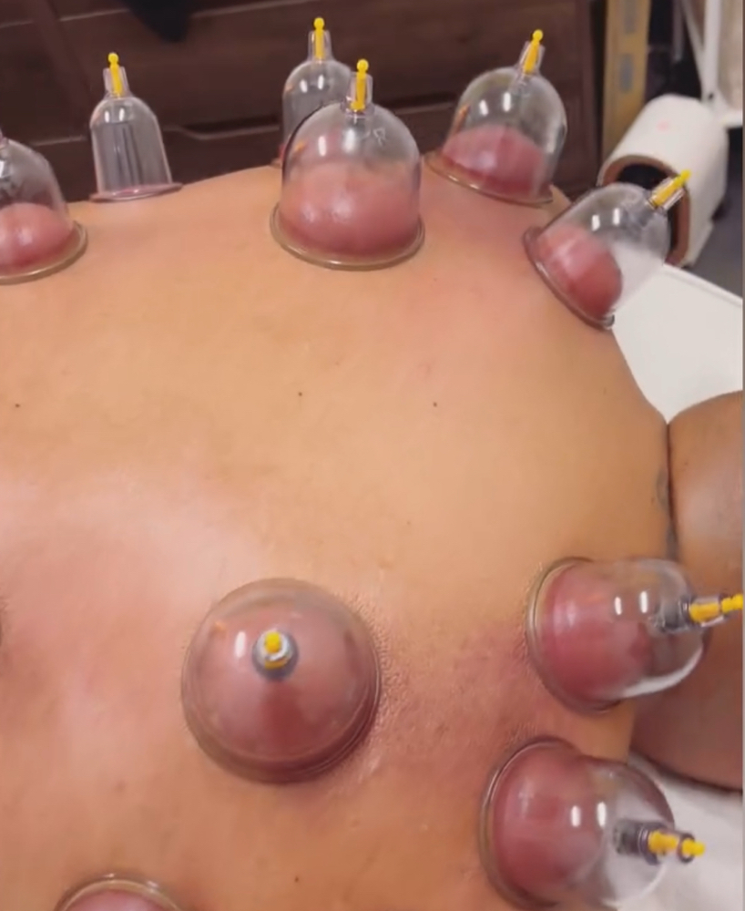 Cupping Therapy