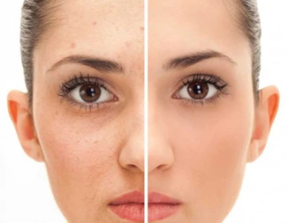 Light Peel Perfect
