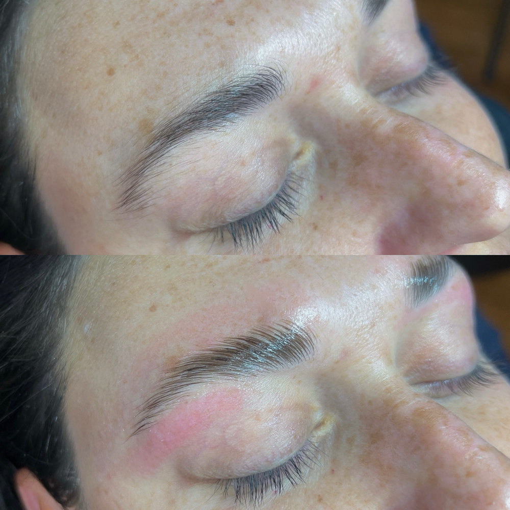 Brow Lift