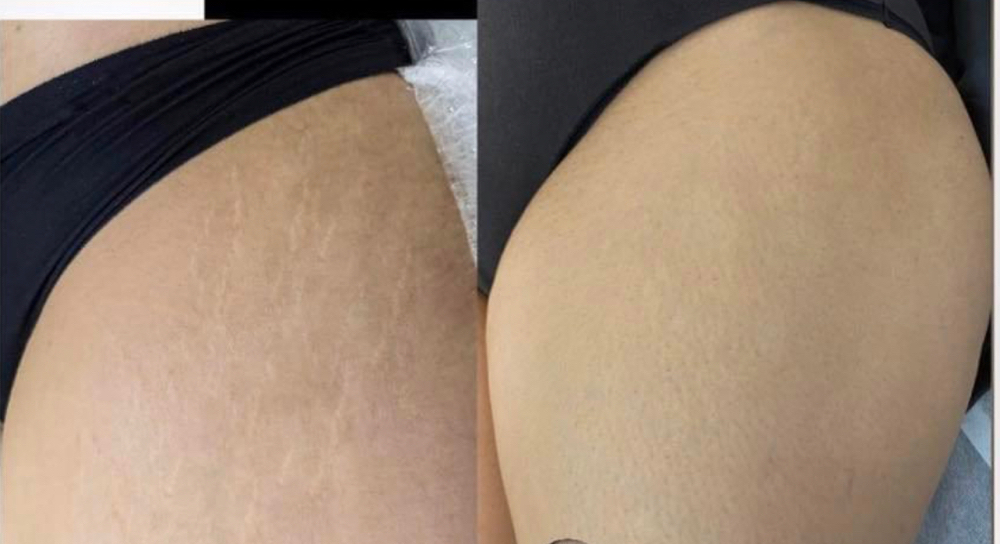 Stretch Mark Rejuvenation