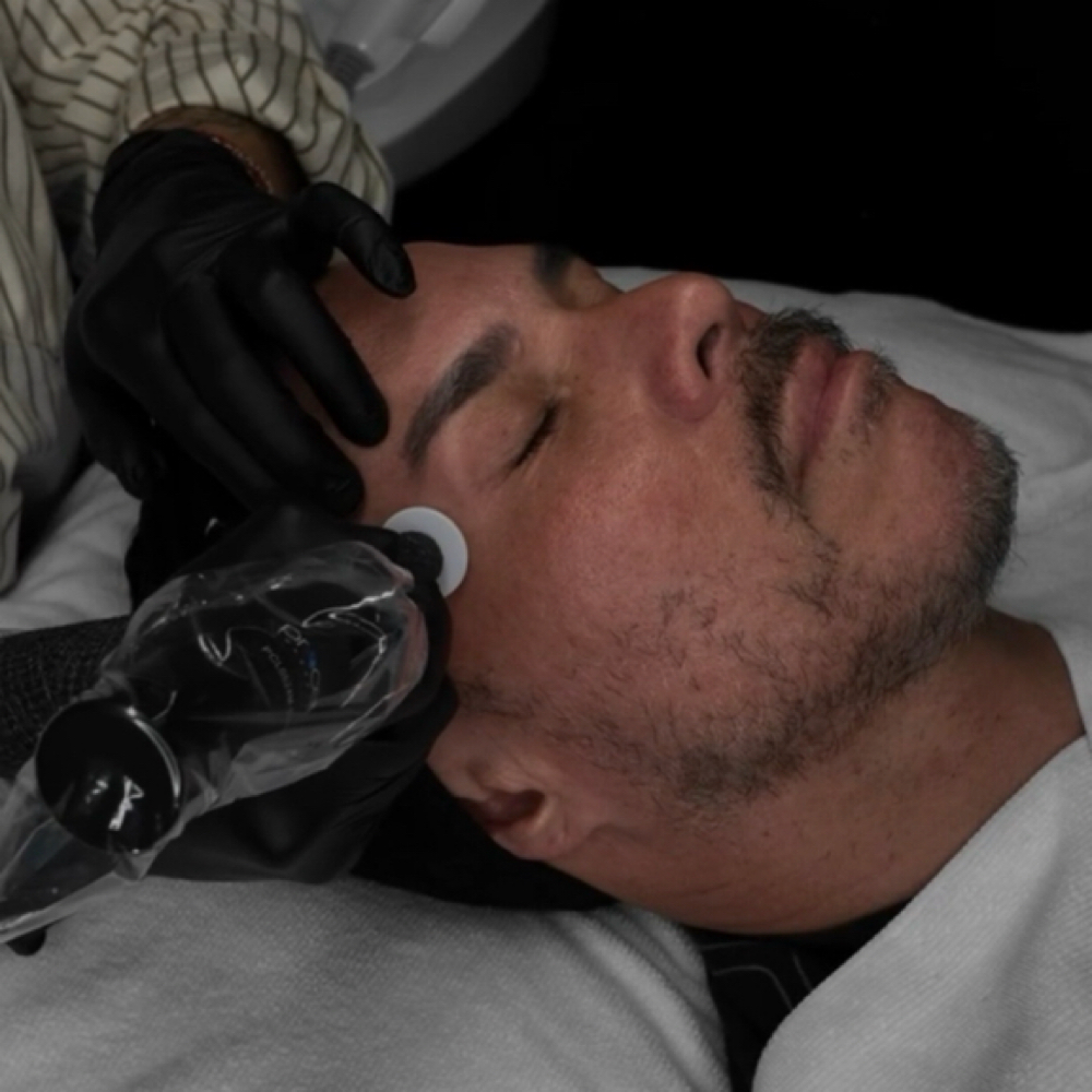 Procell Microchanneling Infusion at Piel Studio in Fullerton, CA