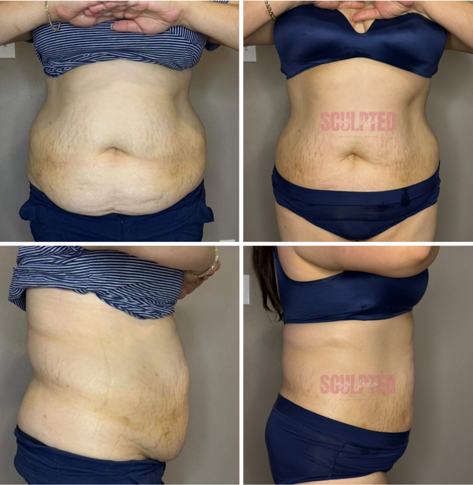 Cavitation 360° at Sculpted by Lluvia in Weslaco, TX