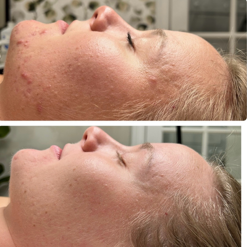Once A Month Acne ExtractionsFacial at Skincare by Carmen Dindo in Sarasota, FL
