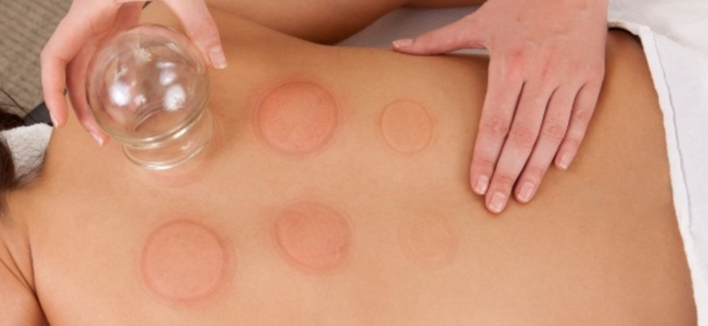 Cupping Therapy