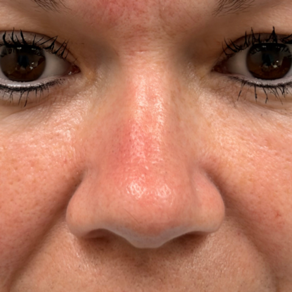 Fibroblast -Nose at Skin Fixation & Esthetic Training in Port Saint Lucie, FL