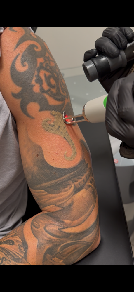Laser Tattoo Removal