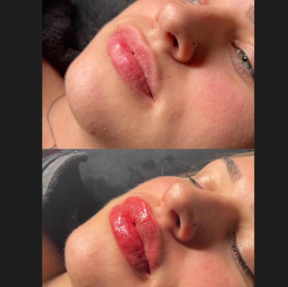 Lip Filler 2 ML at Studios Secrets in Dallas, TX