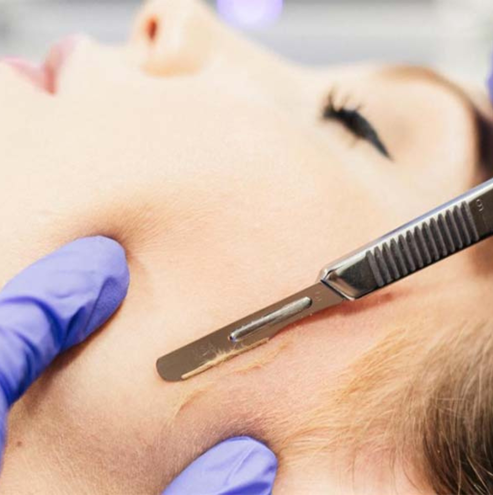 Dermplane Facial at Illuminate Dentistry & Aesthetics in St. Joseph, MO