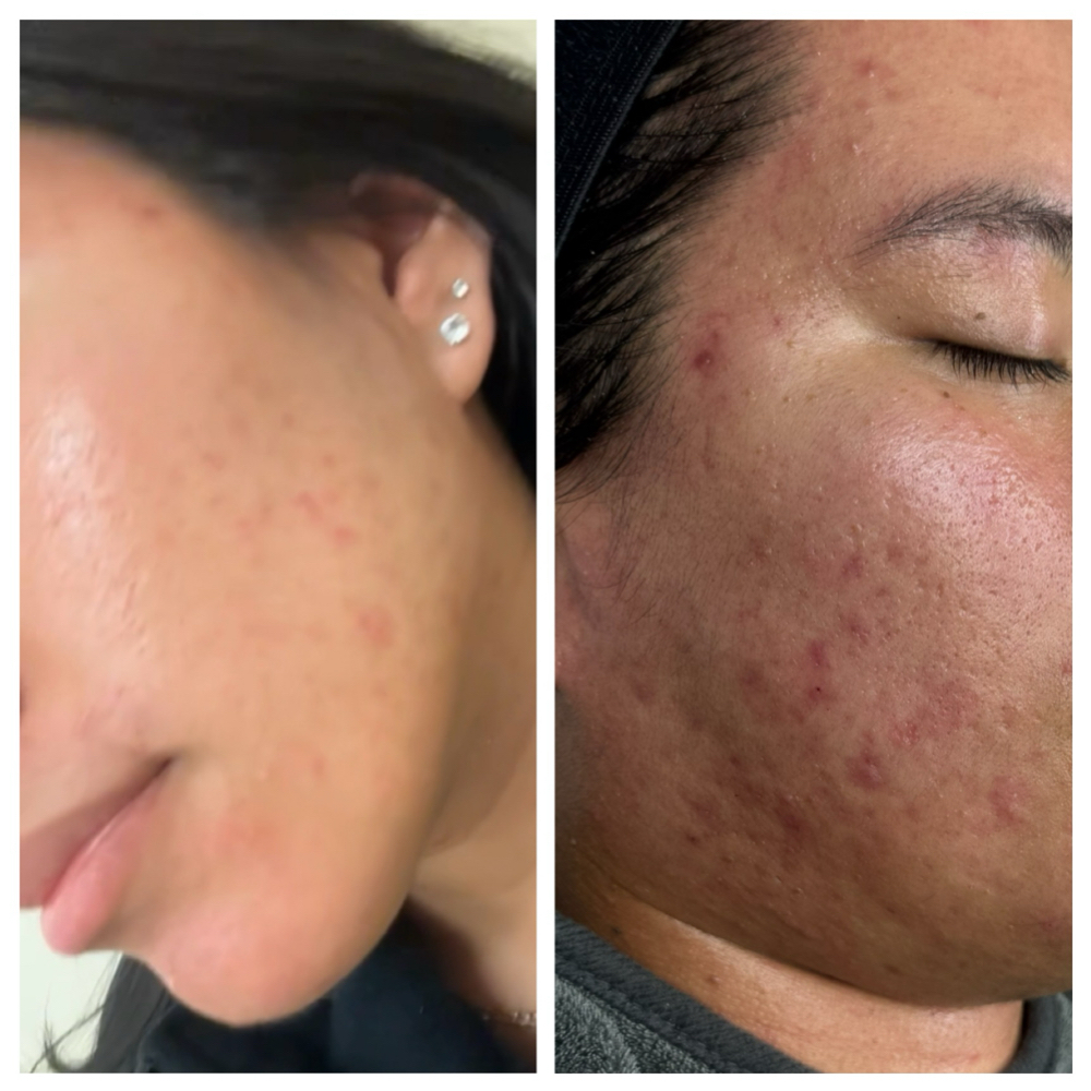 Advanced Acne Clarifying peeling at Beverly Beauty Skincare and spa in Chicago Il, IL