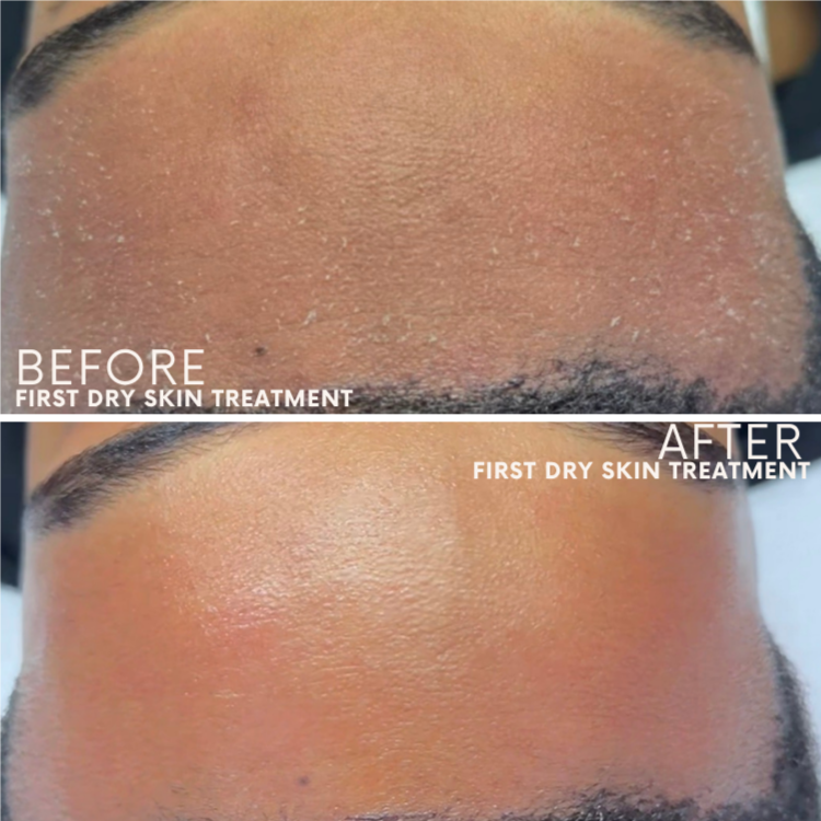 Corrective Peel Series at Glow Aesthetics Studio in Atlanta, GA