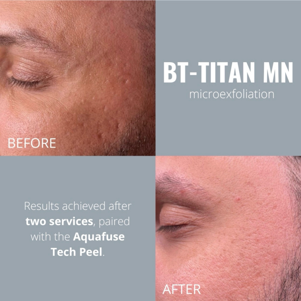 Microexfoliation Add-On at Graceful Skin Facial Studio in Magnolia, TX