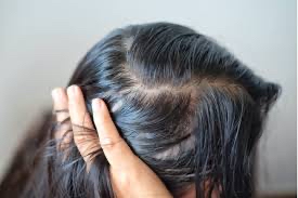 Scalp Treatment