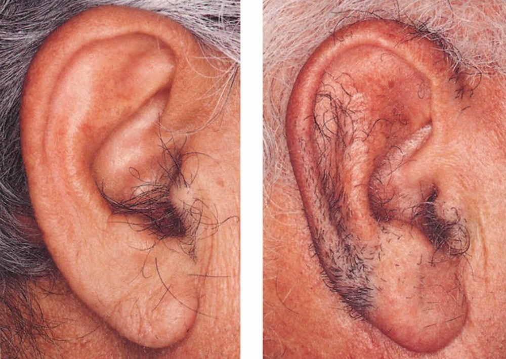 Ear Wax