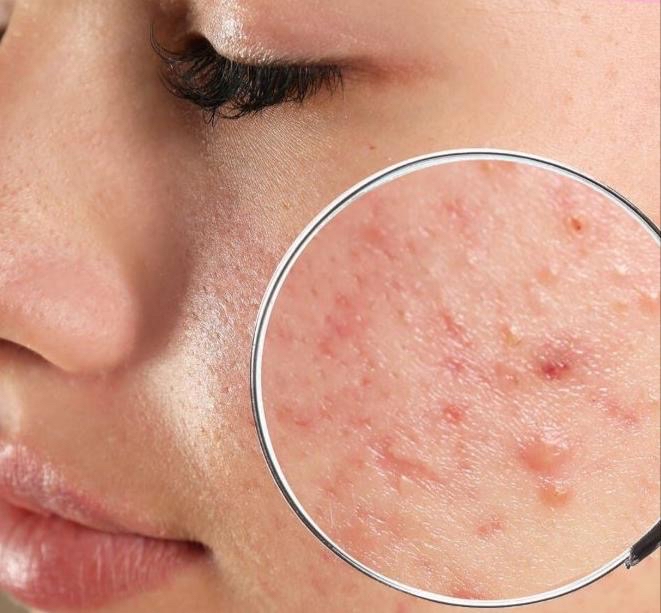 Acne Treatment. Tratamiento BHA.