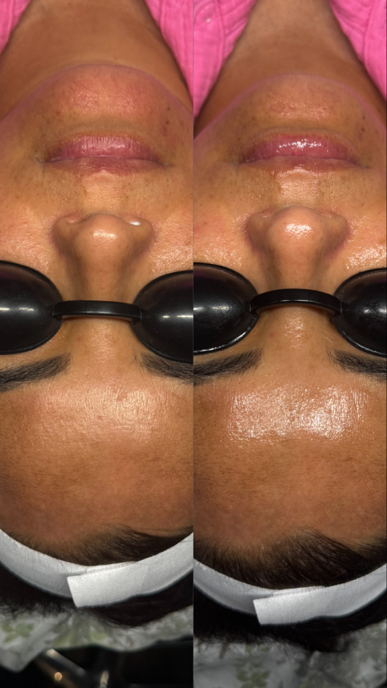 Basic Customized facial