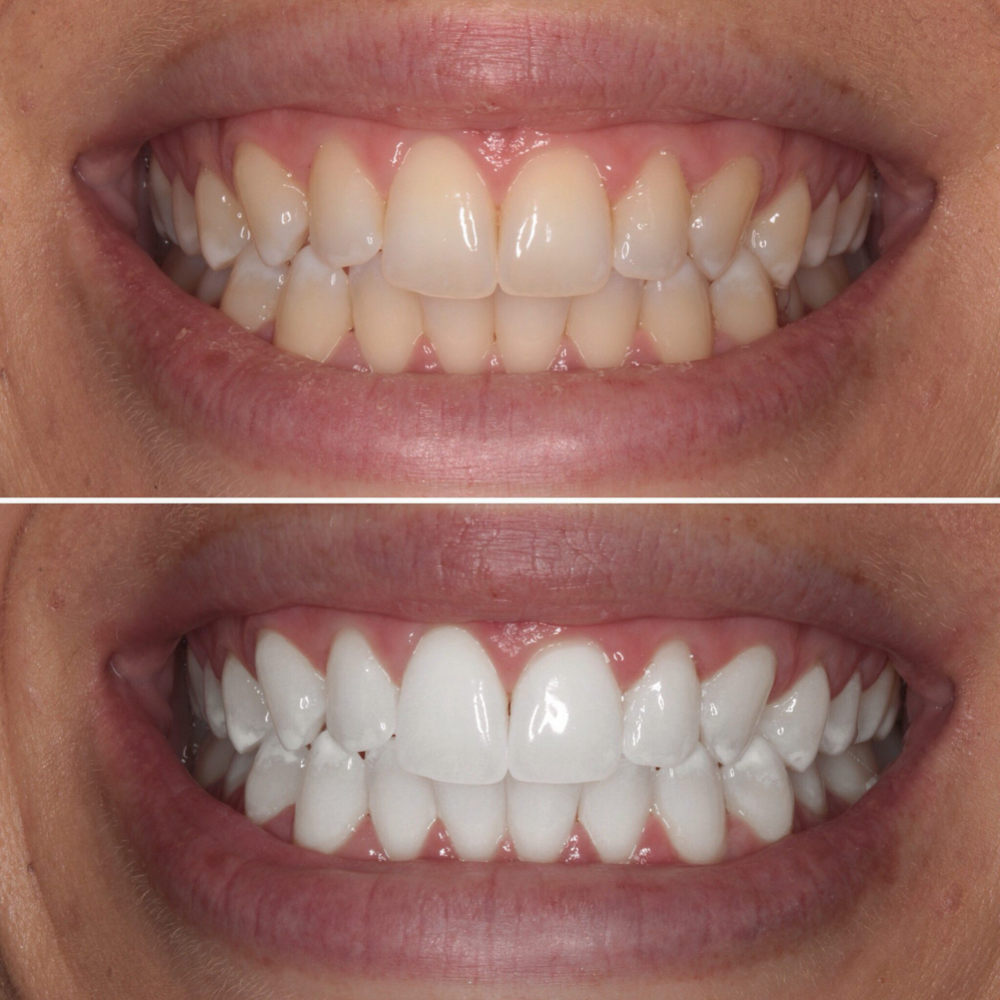 Teeth Whitening at Luxury Lashes by Lex in Chandler, AZ