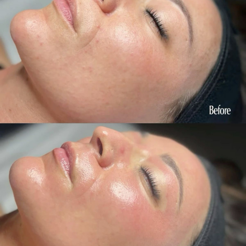 Microneedling Facial at VeleaRaeStudio Waxing Tempe Arizona in Tempe, AZ