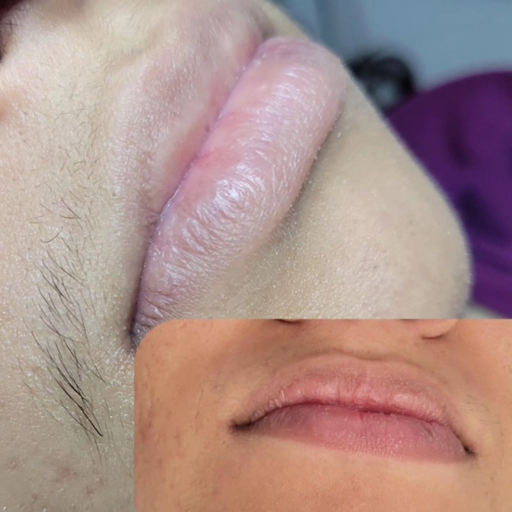 Lip Wax (Upper Or Lower) at KMED Spa LLC in East Orange, NJ