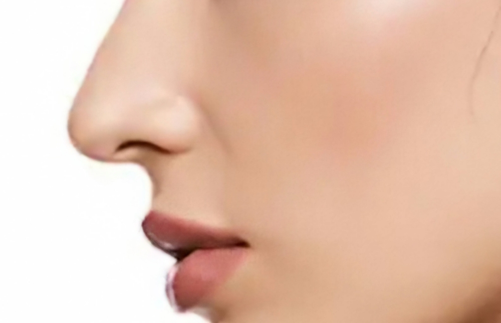 Ultherapy Mid Face