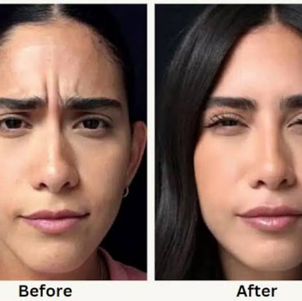 Baby Botox at Studios Secrets in Dallas, TX