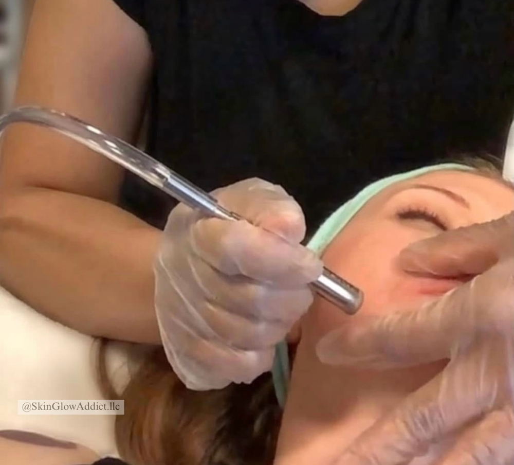 Microdermabrasion Addon