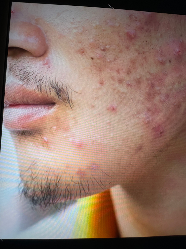 Acne Customized Facial