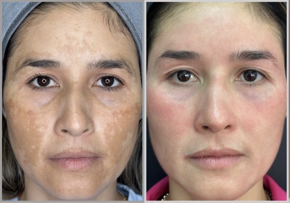 Cosmelan (Tratamiento para Melasma)