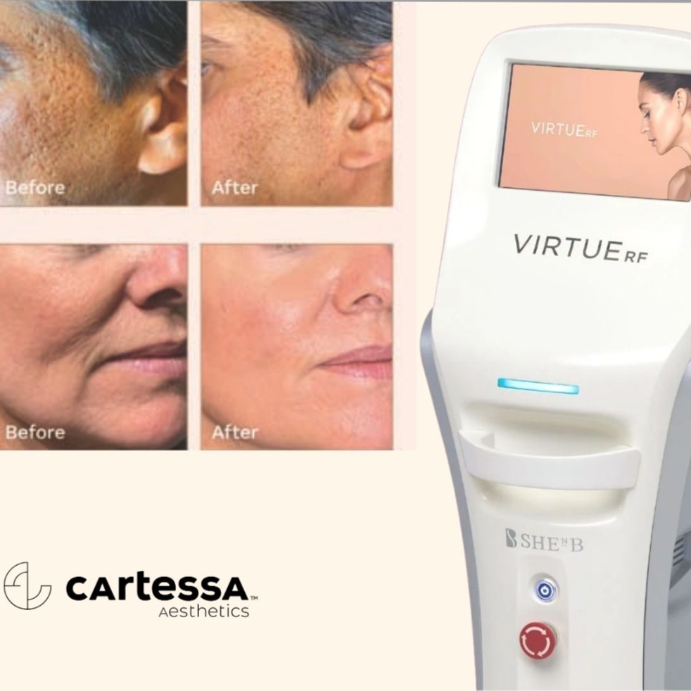 Virtue RF  Face & Neck $750 at The Skin Bar & Med Spa in Bryant, AR