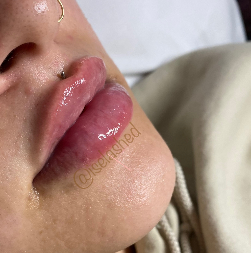 Hybrid Doll Lip 1ml ( Needle & Pen)