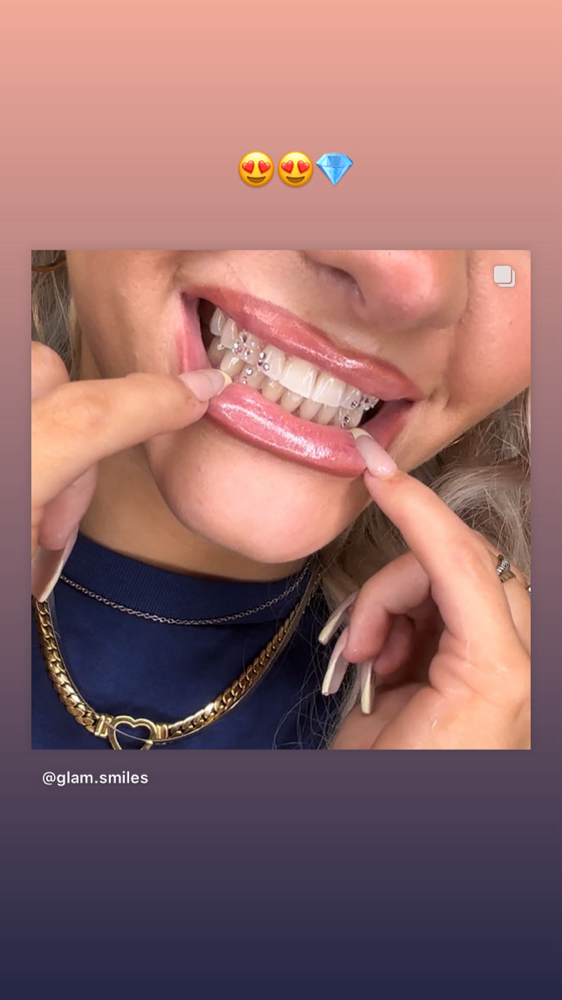 Tooth Gems