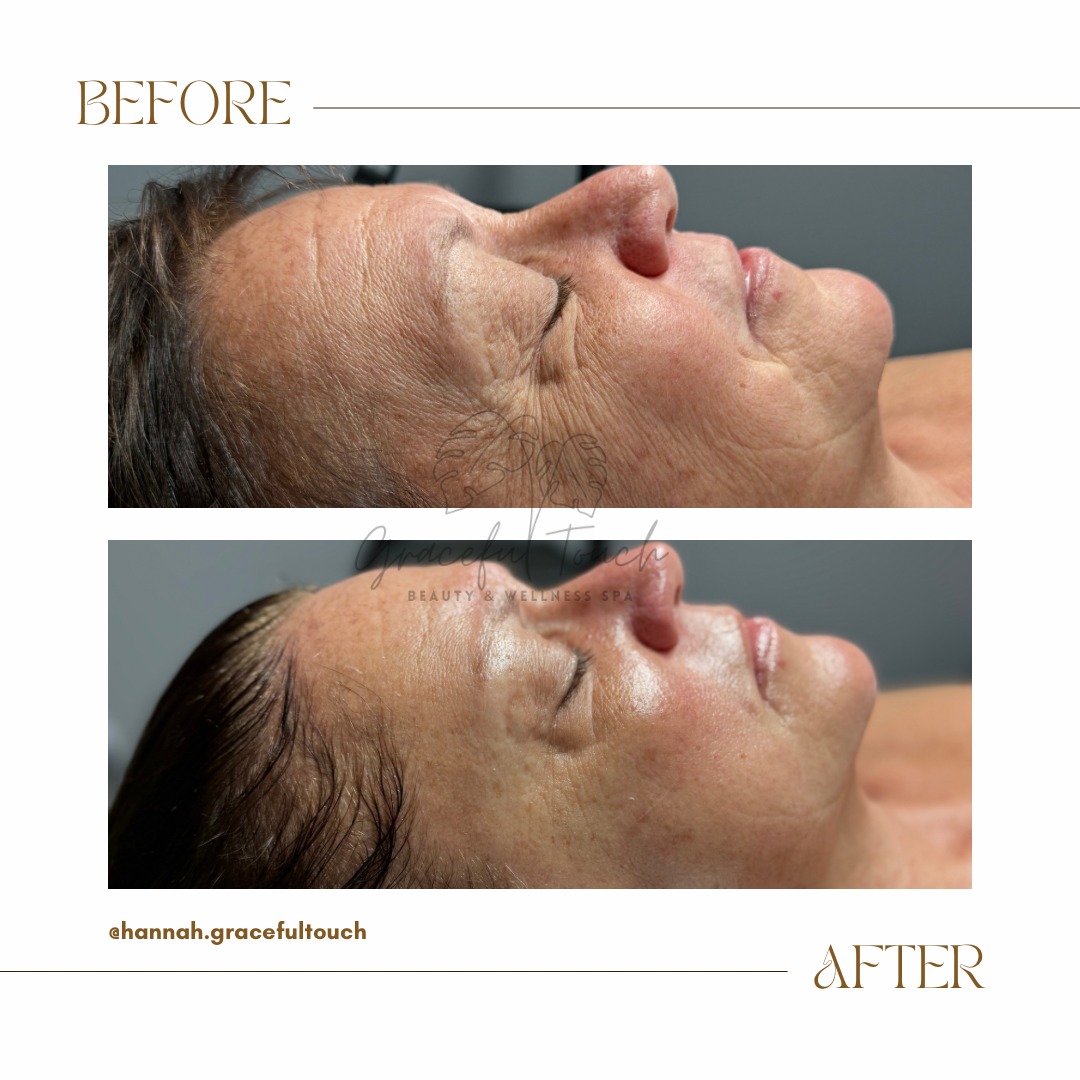 Vtox Lift & Firm Facial