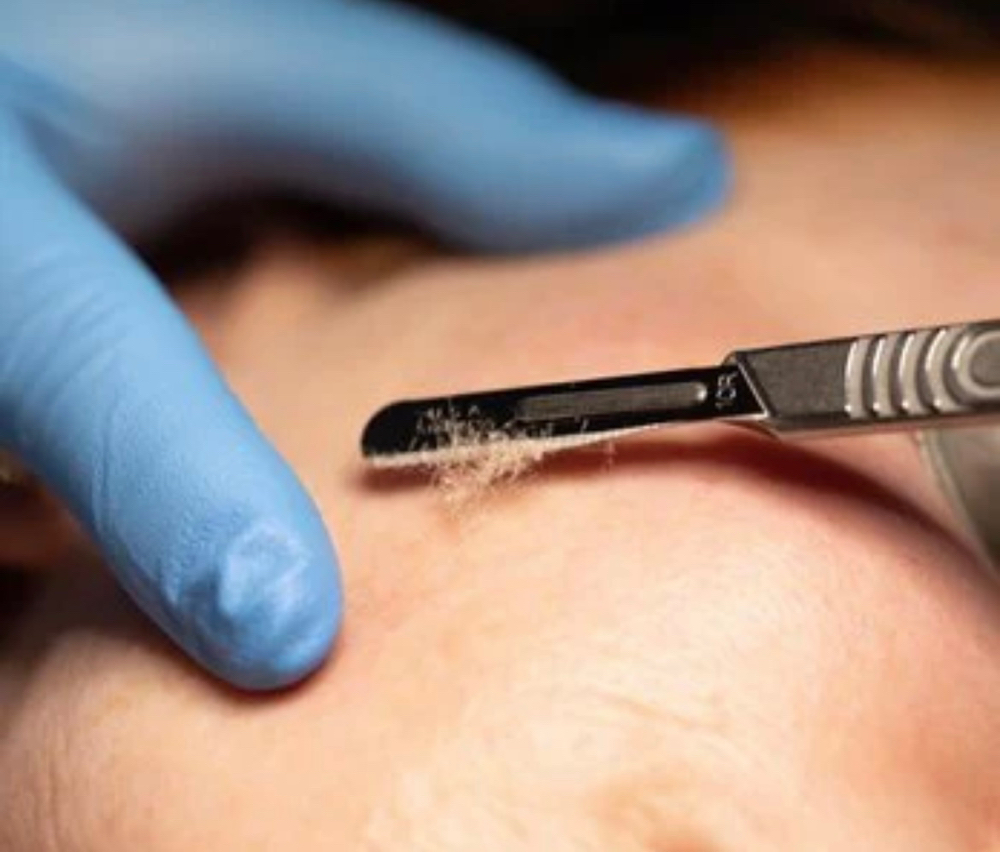Dermaplaning