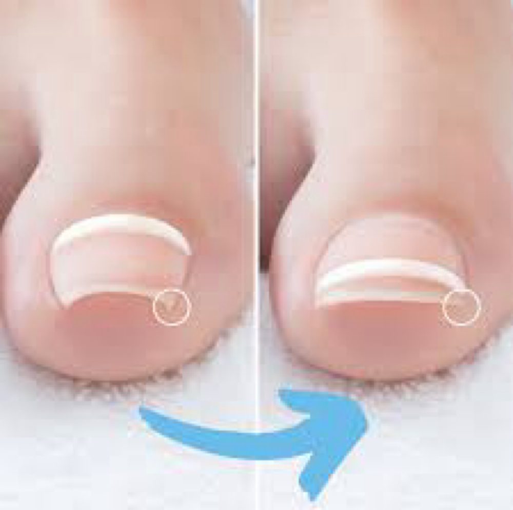 Meraki’s Onyfix Nail Correction Care at Meraki FootCare in Dayton, OH